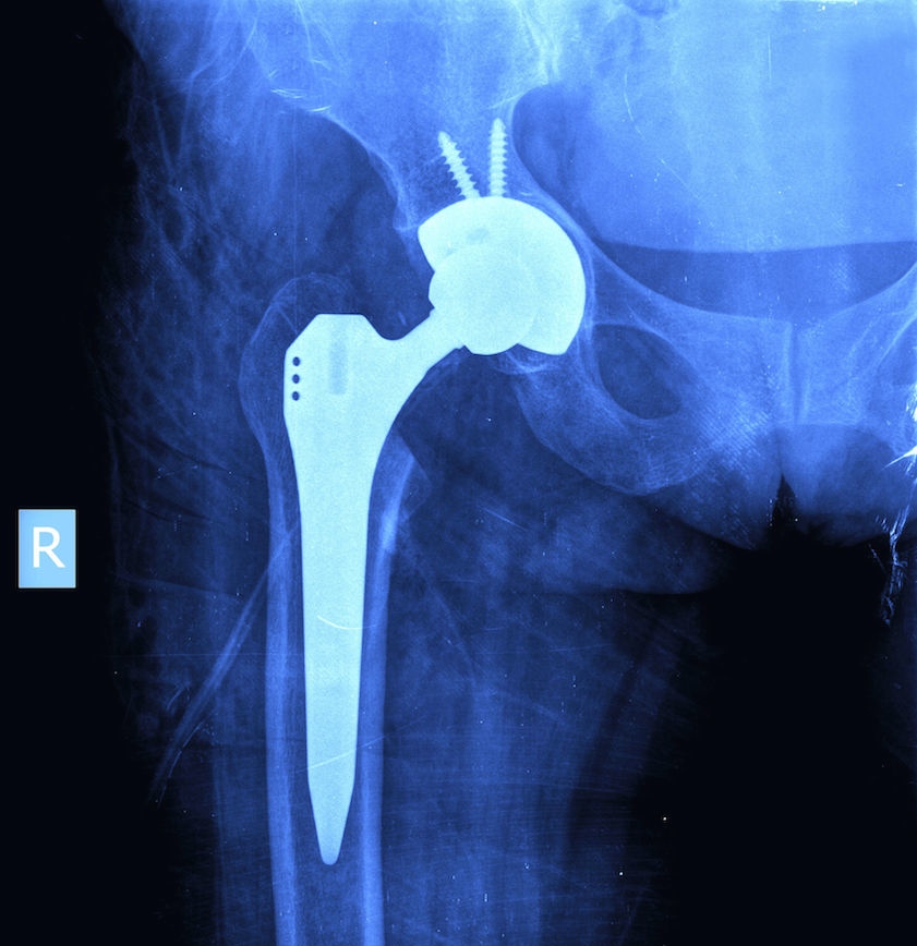 Least Invasive Hip Replacement Surgery